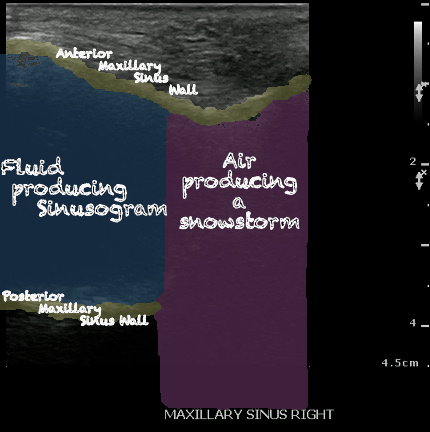 -Figure 30 - Sinusitis .png