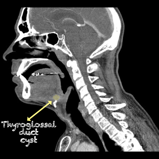 -Figure 37 - Thyroglossal Duct Cyst CT with Color.png
