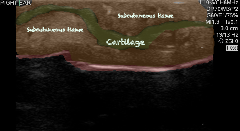-Figure 4 - Chondritis with Color.png