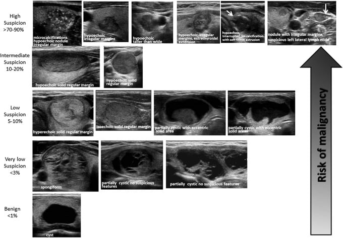 -Figure 40 - ATA Nodule Sonographic Patterns and Risk of Malignancy.jpg