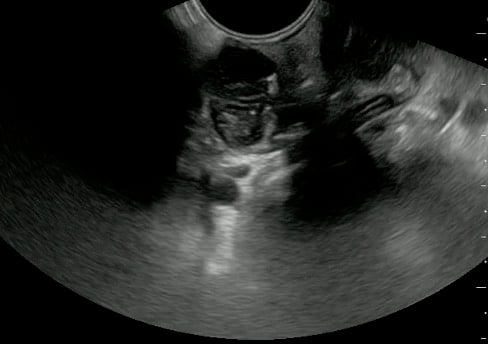 -Figure 42 - Normal Tonsil.jpg