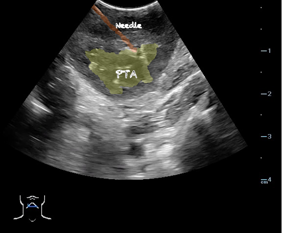 -Figure 46- PTA Aspiration with Color.png