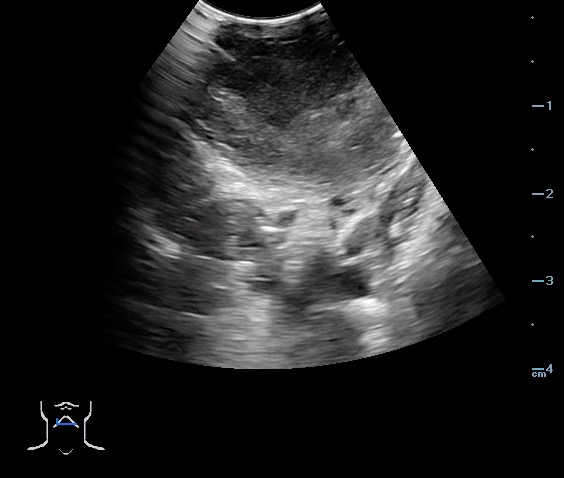 -Figure 49 - PTA Aspiration Resolution.jpg