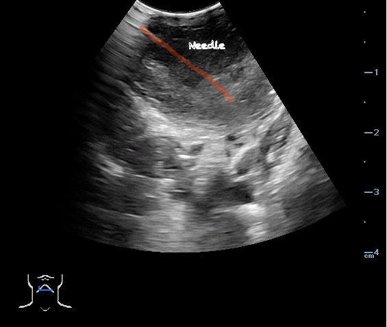 -Figure 50 -PTA Aspiration Resolution with Color.png