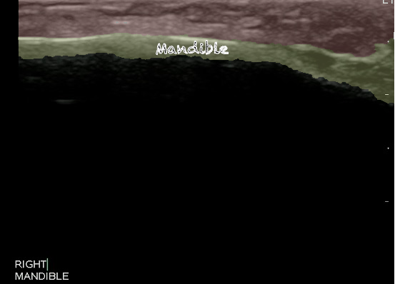-Figure 6 - Normal Mandible.png