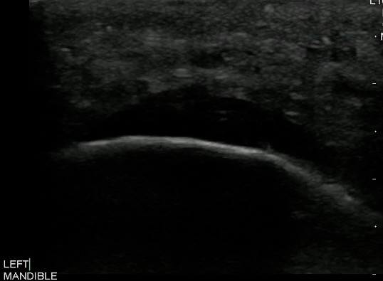 -Figure 7 - Mandibular Periapical Abscess.jpg