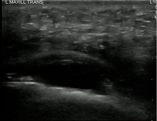 -Figure 8 - Maxillary Periapical Abscess.jpg
