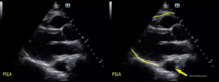 Figure 11 parasternal long axis view with descending aorta.jpg