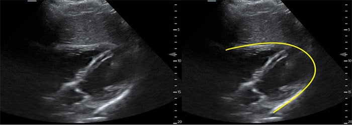 Figure 2. Normal subxyphoid cardiac view_.jpg