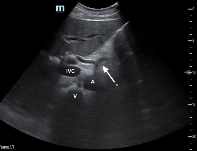 Figure 3 Proximal aorta with celiac trunk.jpg