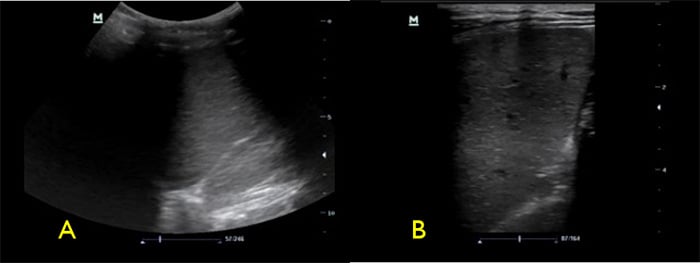 Figure 4 Spleen with low frequsncy (A) vs high frequency (B) transducers.jpg