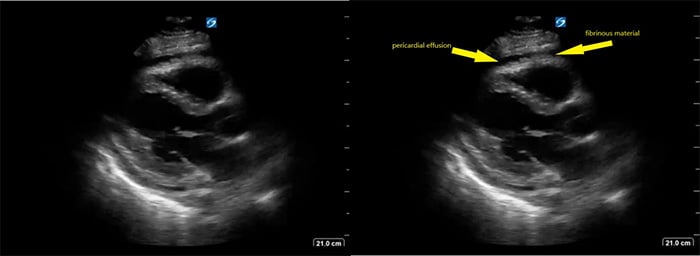 Figure 5 Parasternal long axis view of heart with fibrinous pericardial effusion.jpg