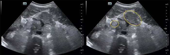Figure 6 Numerous periaortic lymph nodes.jpg