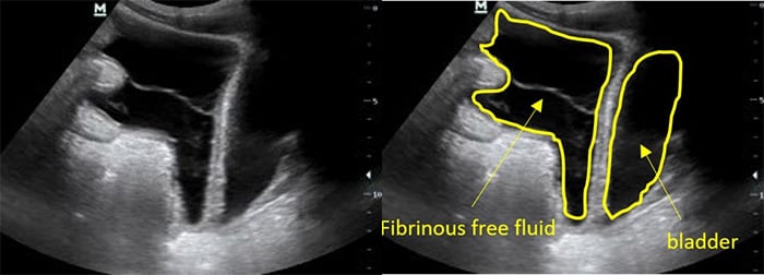 Figure 7 Fibrinous ascites in pelvis sagittal view.jpg