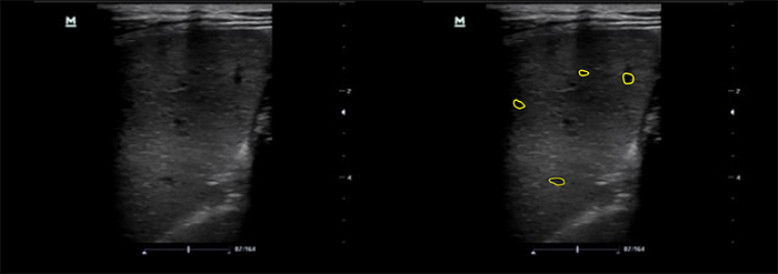 Figure 9 Spleen with microabscesses using linear transducer.jpg