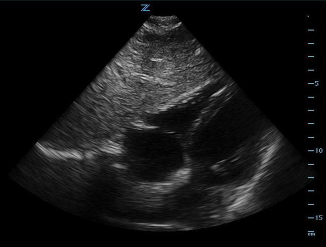 Figure 2 - Subxiphoid view.jpg