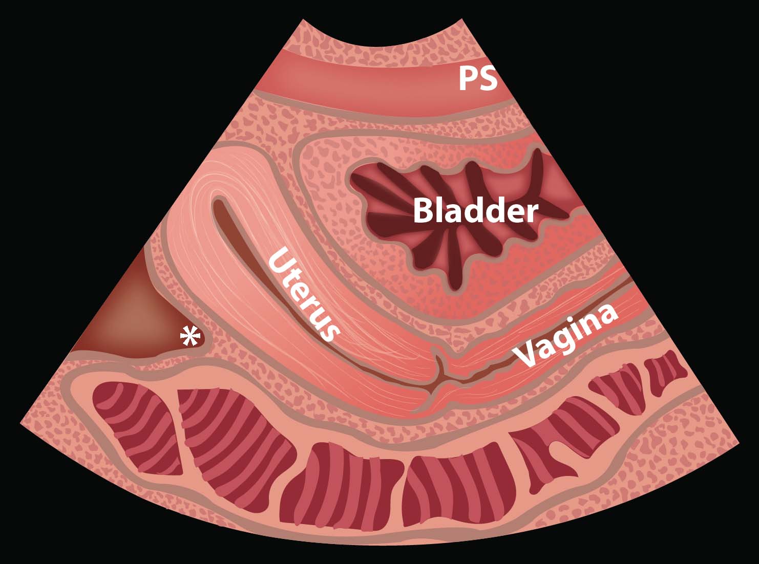 Ill 8_Pouch of Douglas in female.jpg