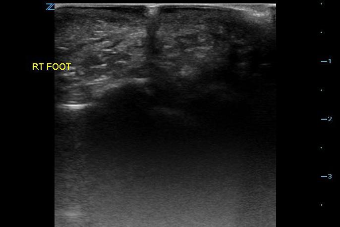 Figure 2- Glass in foot with shadowing.jpg