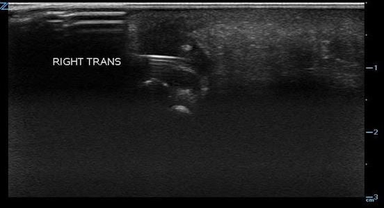 Figure 3. Reverberation from metal foreign body.jpg