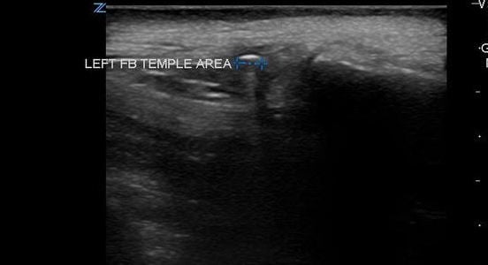 Figure 4. Comet tail artifact from metal foreign body.jpg