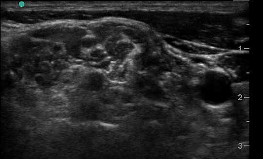 Figure 2a. Transverse view through the interscalene space.jpg