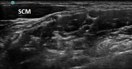 Figure 6. SCM with proper head turn.jpg