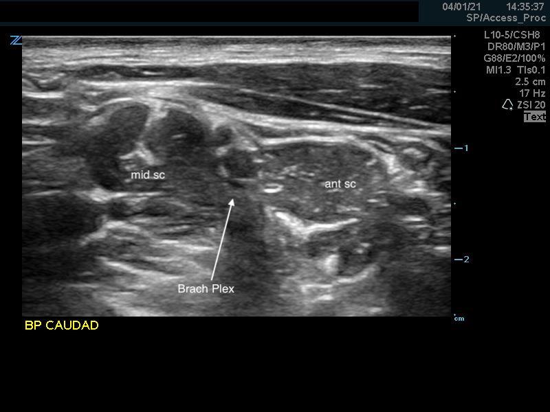 Figure 8. Anterior scalene muscle caudal.jpg