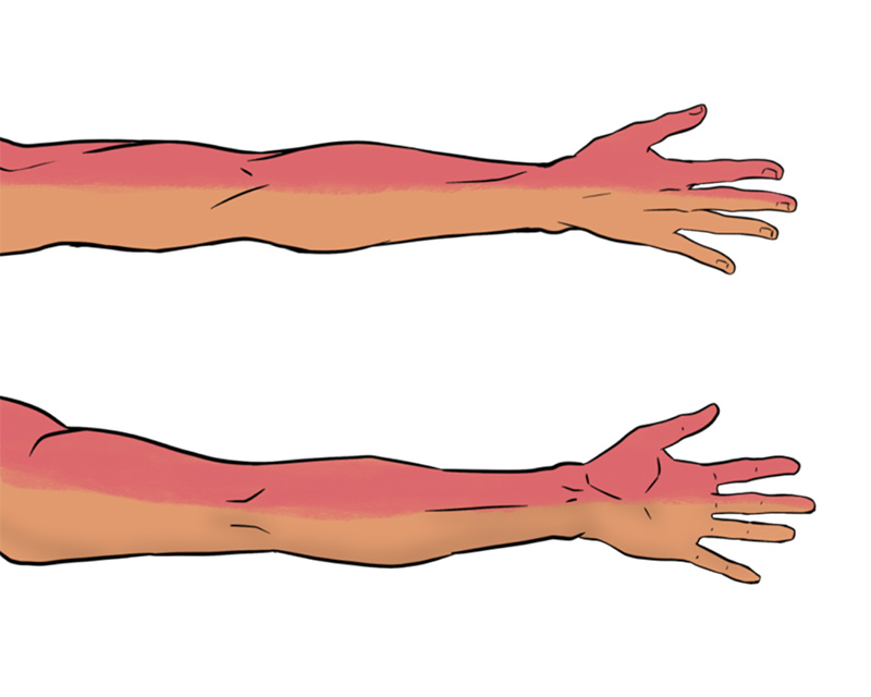 Ill 2 - Posterior Distribution of Interscalene NB.jpg