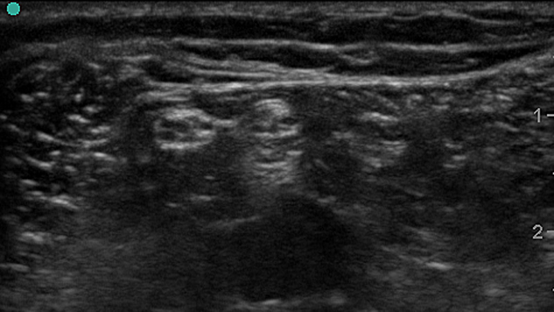 Figure 1a. Ultrasound Image of Peripheral Nerves.jpg