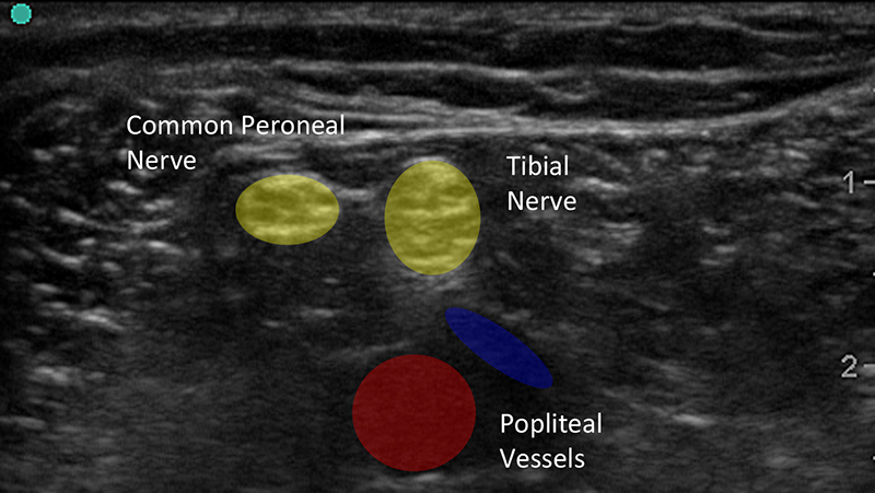 Figure 1b.  Ultrasound Image of Peripheral Nerves with Labels.jpg