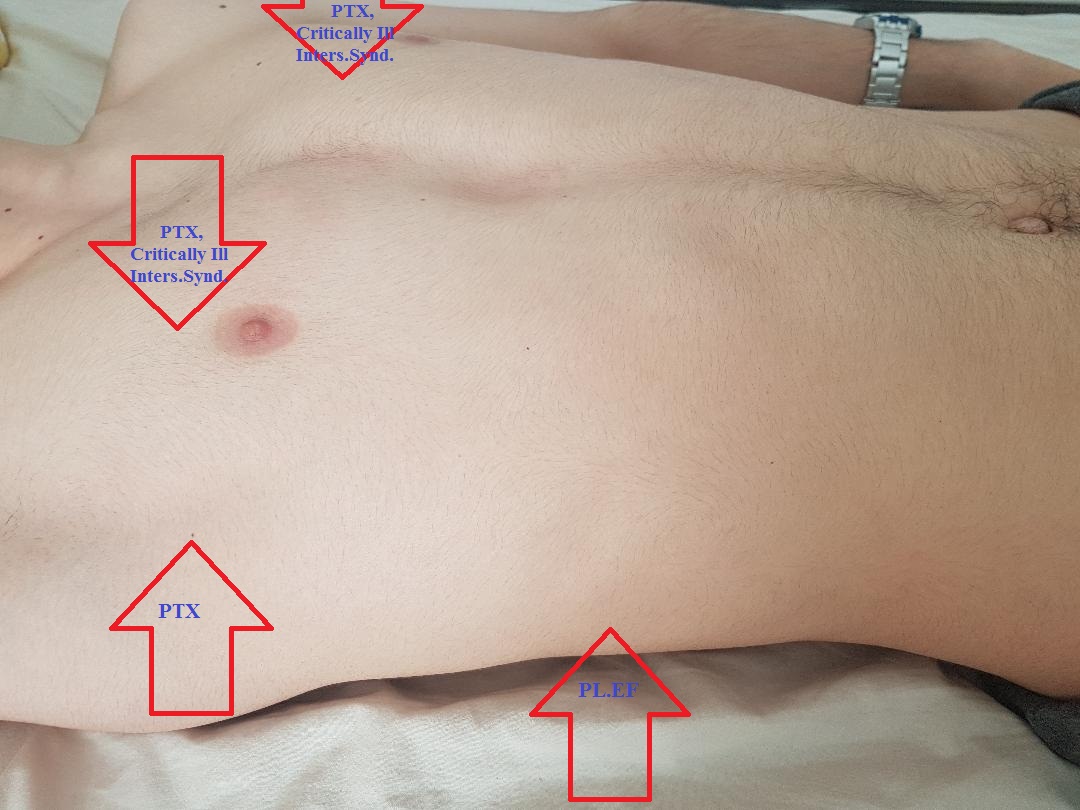 Image 10 - Surface anatomy to guide best scanning approach for pneumothorax (ptx), pleural effusion (pl.ef.), and interstitial syndrome-lung disease (inters.synd).jpg