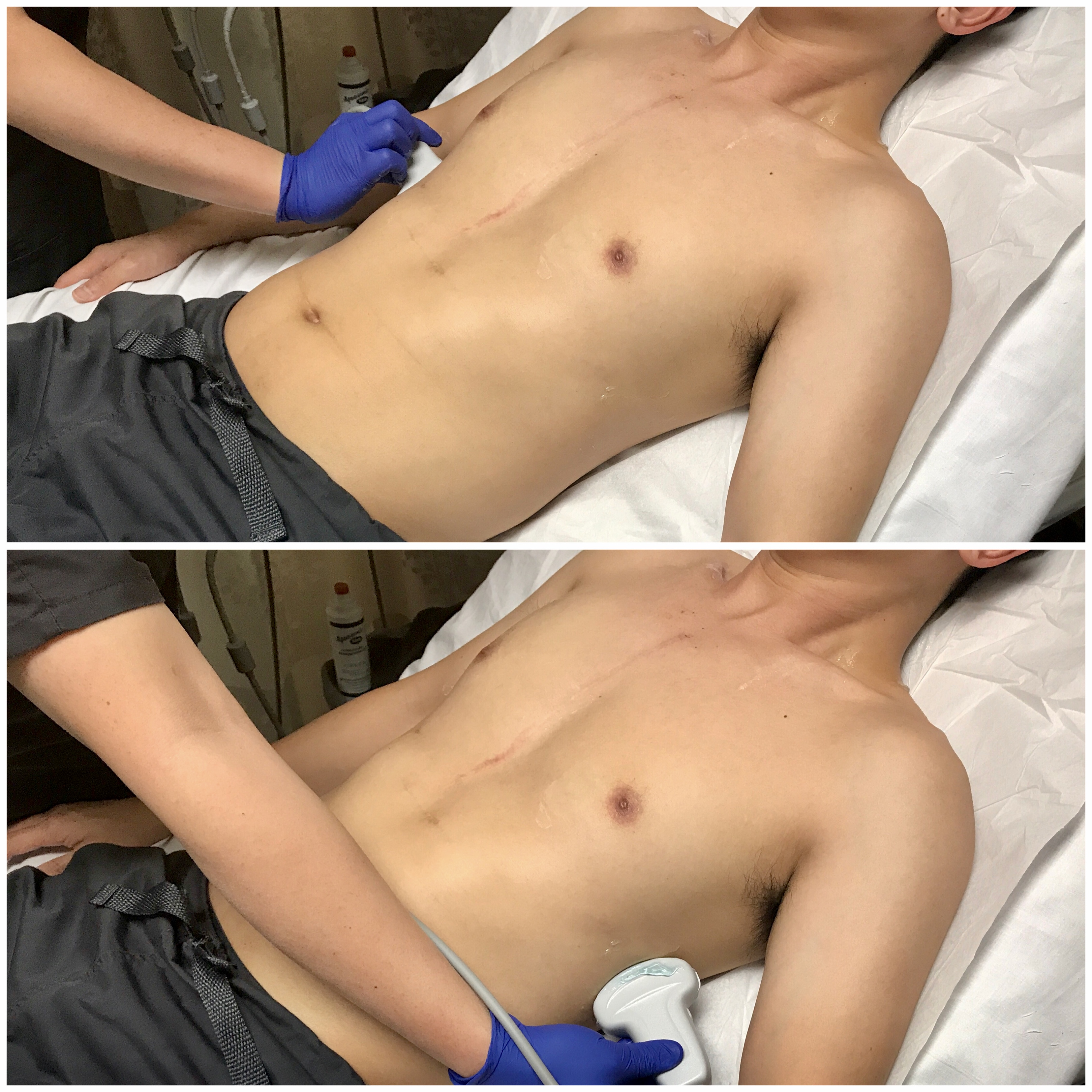Image 13 - Transducer placement and orientation for evaluating for pleural effusion in the semi-upright patient.jpg
