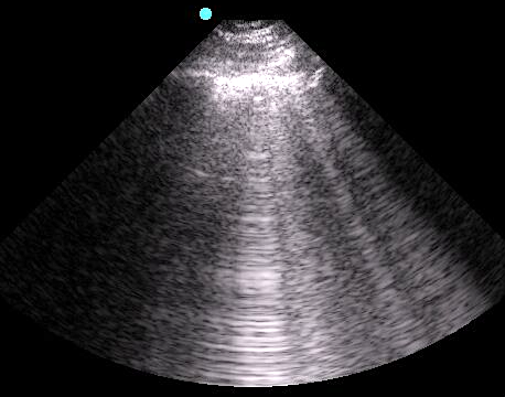 Image 5 - B-lines.png