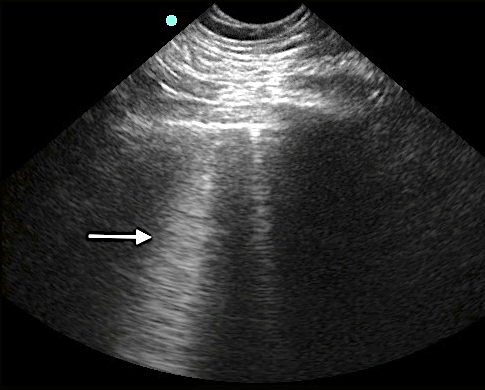 Image 6 - Lung rocket.png
