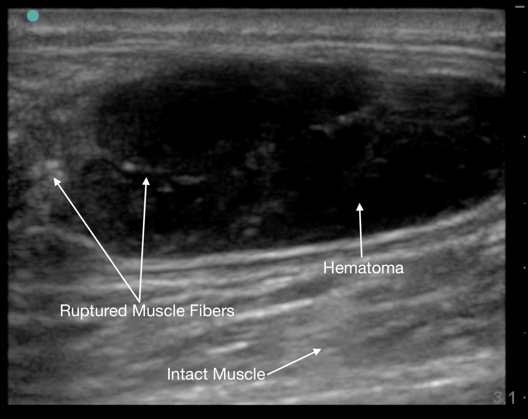 MSK-Figure 12 - Muscle tear.png