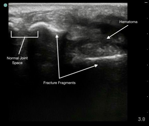 MSK-Figure 6 - Colles fracture.jpeg
