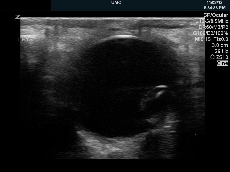 FIG 7- The lens is noted in the posterior globe, in the shape of a coffee bean..jpg