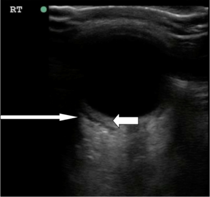 Figure 10- Orbital cellulitis.png