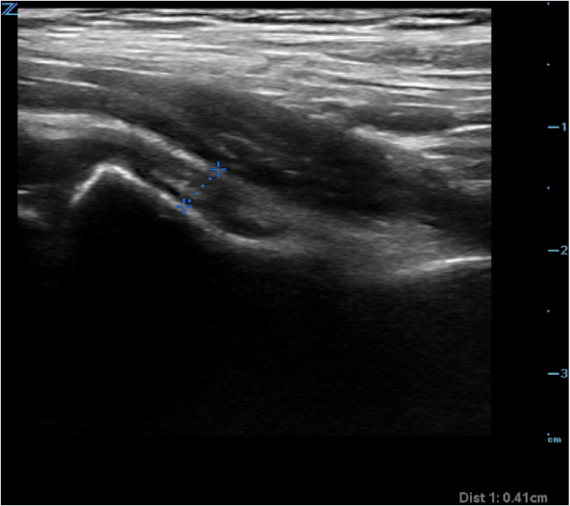 Figure 3.  Measurement of hip joint fluid thickness.png