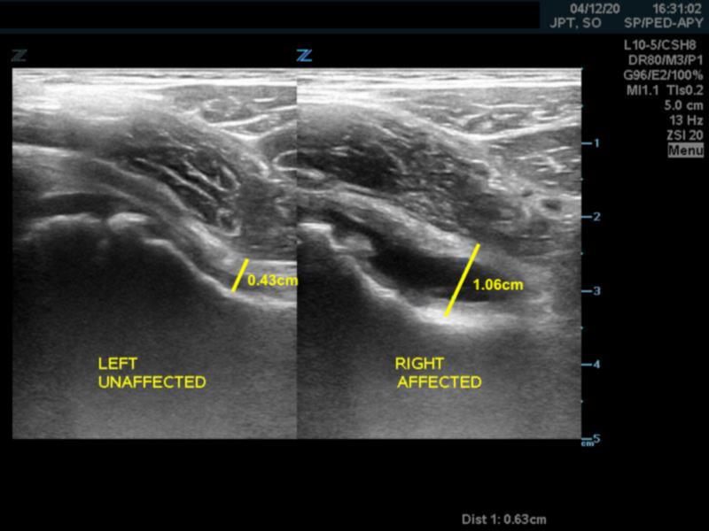 Figure 4. Capsular-synovial thickness.jpg