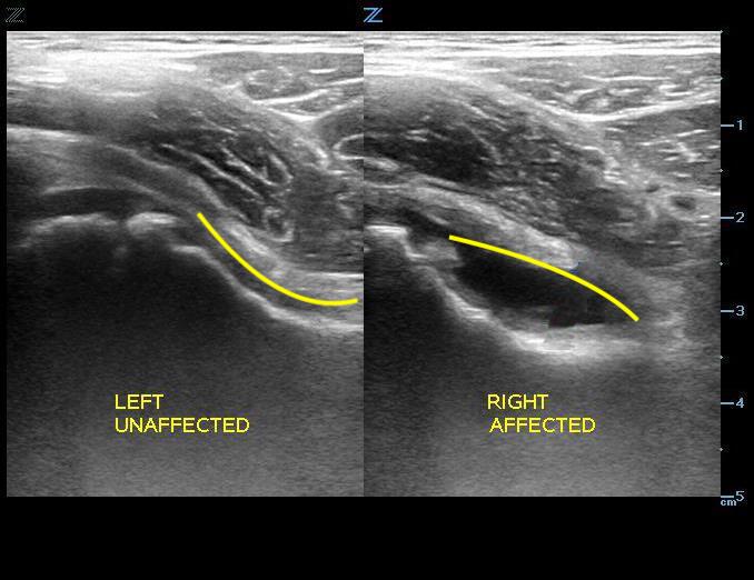 Figure 5.  Hip without effusion.jpg