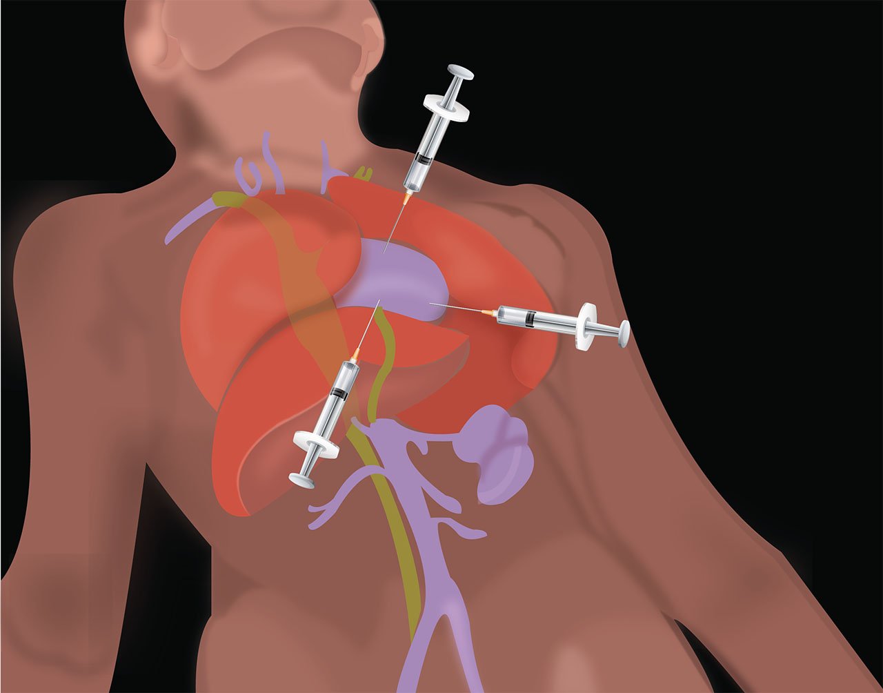 Illustration 1. Schematic view of pericardiocentesis.jpg
