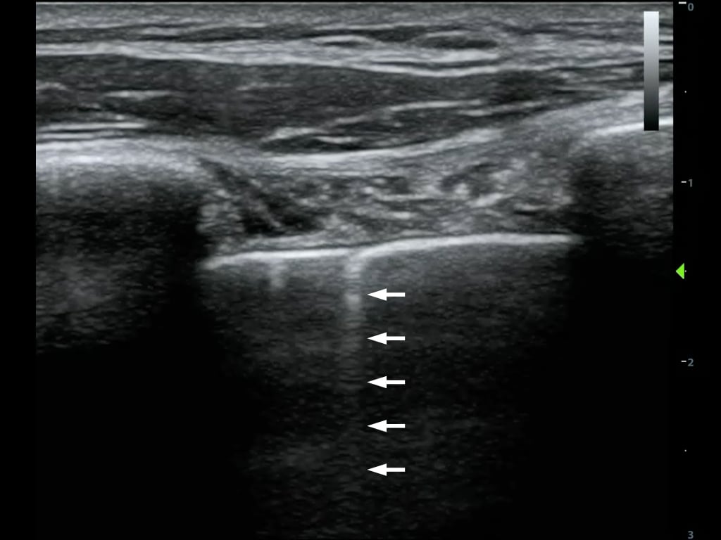 Figure10-Comet tail artifact arising from pleural line.jpeg