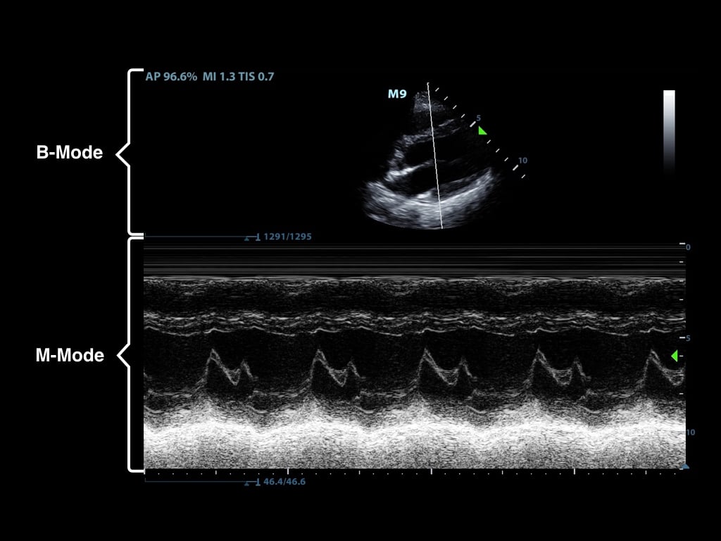 Figure2-M-mode showing movement of the mitral valve.jpeg