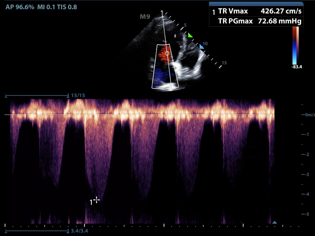 Figure6-Continuous flow doppler of tricuspid regurgitation.jpeg
