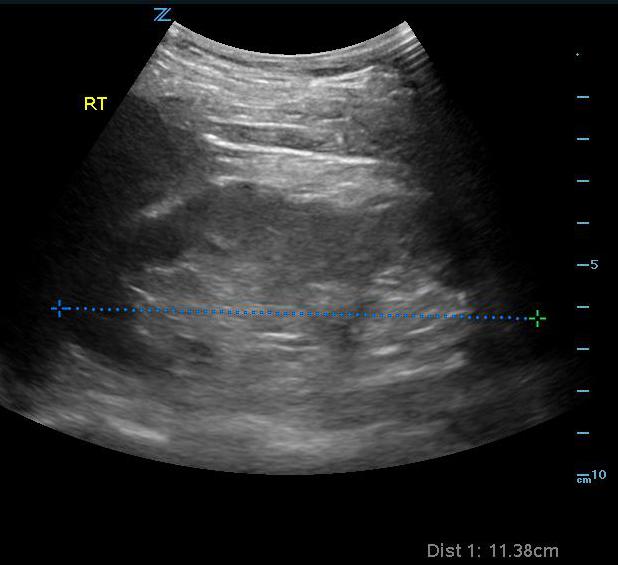 Figure 1- Measurement of normal right kidney in longitudinal view.jpg