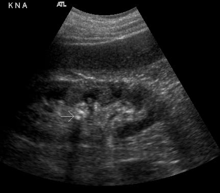 Figure 6- Renal stones (arrow) with shadowing.jpg