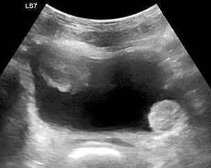 Figure 8- Bladder mass.jpg