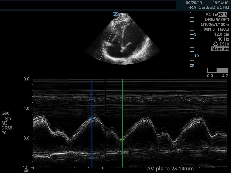 figure 10 - normal tapse.jpg