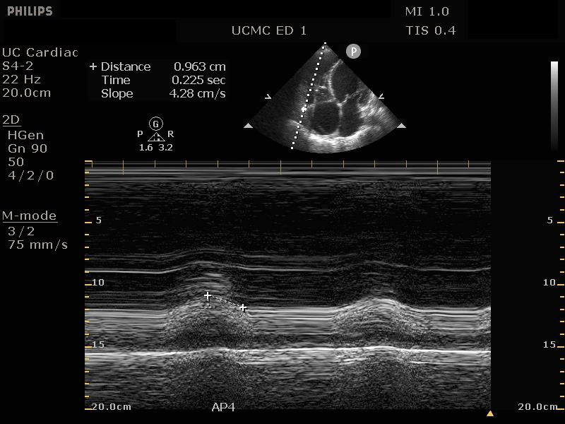 Figure 11- Apical 4 chamber view. M-Mode measurement of TAPSE measuring 9.6mm, indicating d_SI3U.jpg